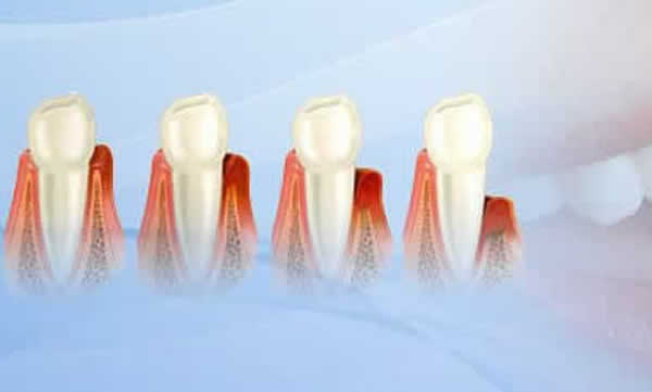 Periodoncia